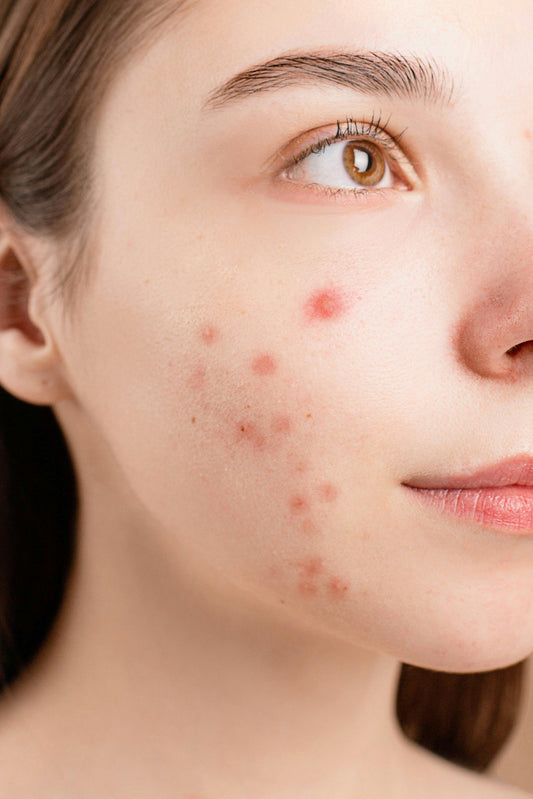 SOPK : Comment reconnaître le Syndrome des Ovaires Polykystiques